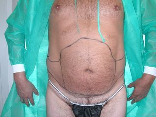 Liposuzione pancia prima vista frontale