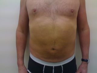 Liposuzione pancia dopo