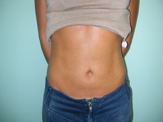 Liposuzione addome e fianchi dopo