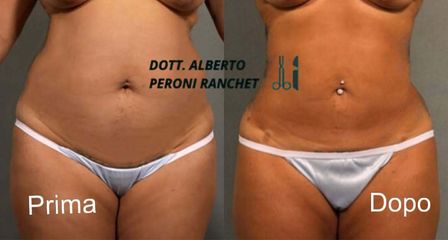 Peroni Ranche Addominoplastica