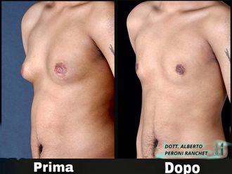 Ginecomastia prima e dopo - 878383