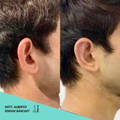 Peroni Ranchet Otoplastica