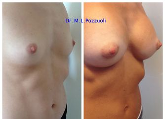Mastoplastica additiva pre e post