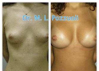 Mastoplastica additiva pre e post
