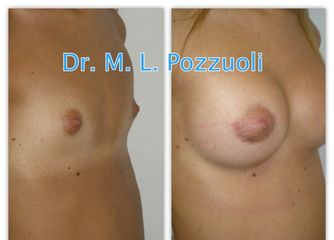 Mastoplastica protesi Mentor pre e post