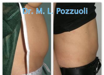 Liposuzione addome pre e post 