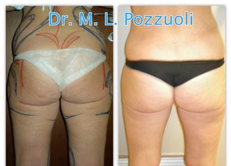 Liposuzione pre e post operatorio 