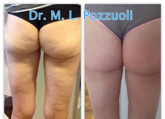 Cellulite e lassità cutanea prima e dopo 