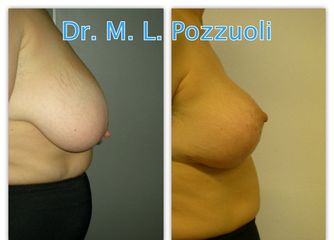 Mastopessi semplice pre e post