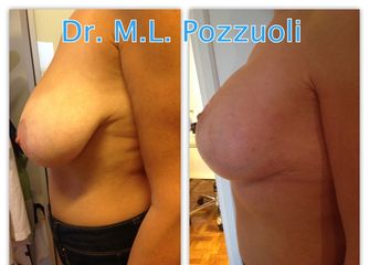 Mastopessi con protesi Mentor pre e post