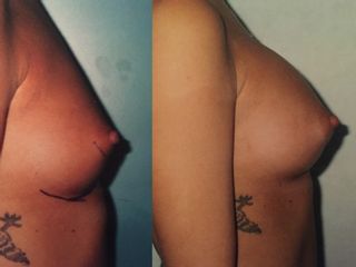 Mastoplastica additiva prima e dopo