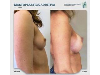 Mastoplastica additiva - Dott. Fioravante Orefice