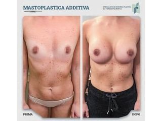 Mastoplastica additiva - Dott. Fioravante Orefice