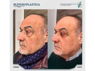 Blefaroplastica - Dott. Fioravante Orefice