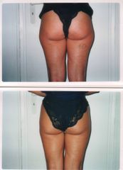 Gluteoplastica - Dott. Fioravante Orefice