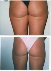 Liposuzione alle culotte de cheval
