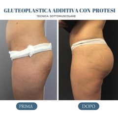 Gluteoplastica - Dott. Fioravante Orefice