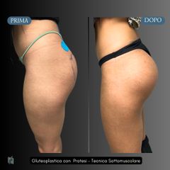 Gluteoplastica con Protesi - tecnica sottomuscolare