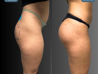 Gluteoplastica prima e dopo - 875010