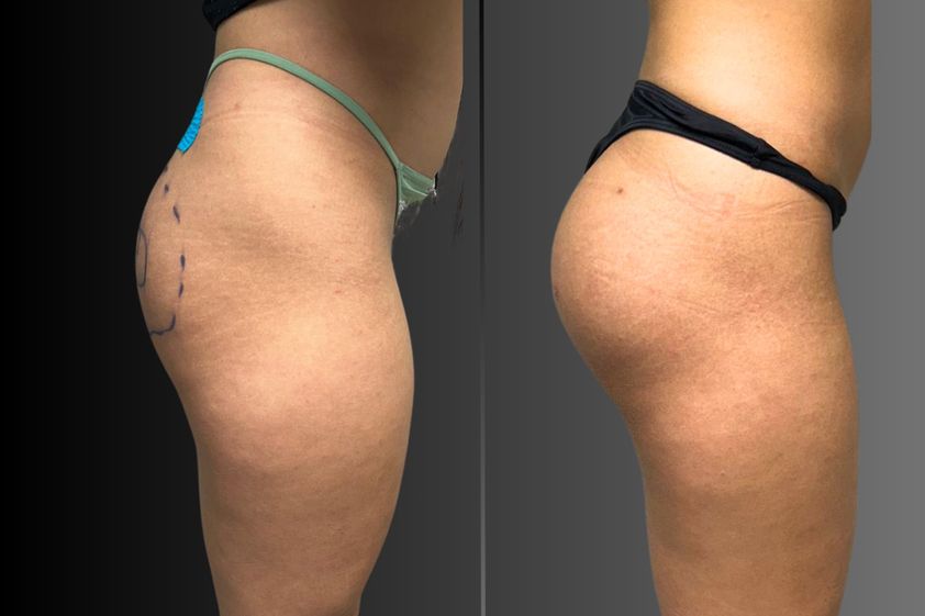 Gluteoplastica prima e dopo - 875010