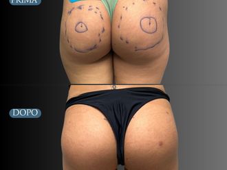 Gluteoplastica prima e dopo - 875011