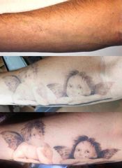 Rimozione tatuaggi - Dott. Riccardo Testa