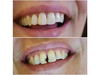 Ortodonzia prima e dopo