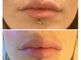 Filler labbra prima e dopo - 879081