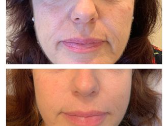 Filler labbra prima e dopo - 879087