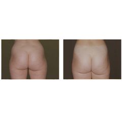 Liposuzione prima e dopo