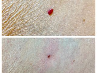 Angioma rubino prima e dopo