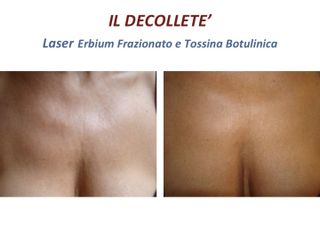 Ringiovanimento del décolleté - Dott. Elena Fasola