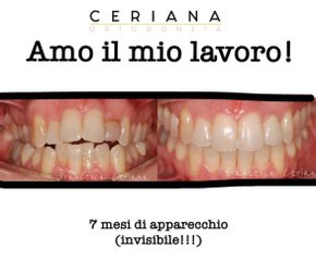 Ortodonzia - Studio ortodontico dott.ri Beppe e Francesca Ceriana