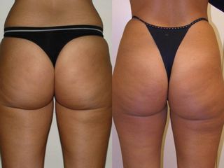 Gluteoplastica prima e dopo