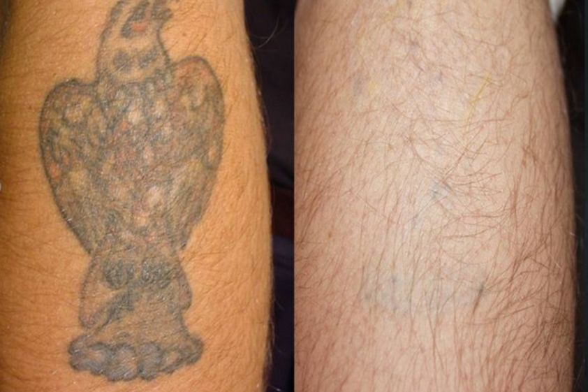 Rimozione tatuaggi prima e dopo - 752051