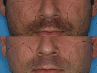 Cicatrici acne prima e dopo