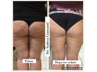 Mesoterapia prima e dopo