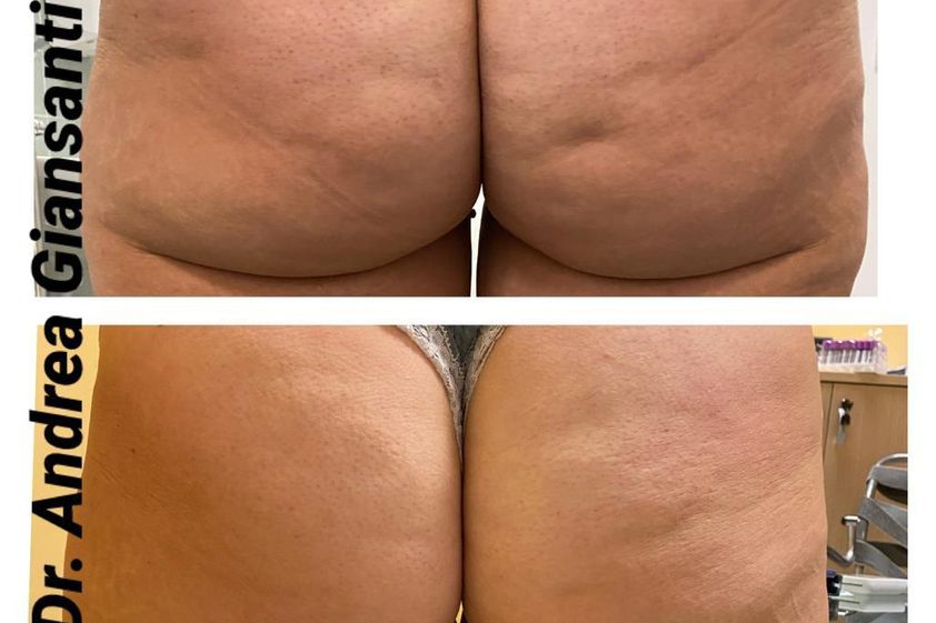 Mesoterapia prima e dopo - 774977