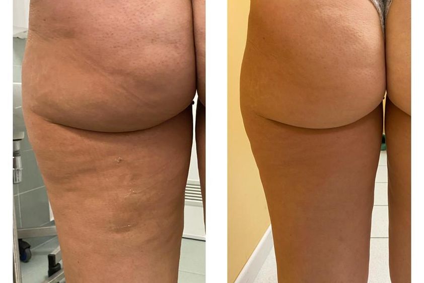 Mesoterapia prima e dopo - 774978