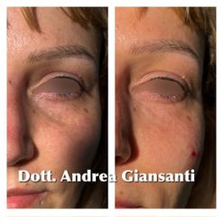 Eliminare occhiaie - Dott. Andrea Giansanti