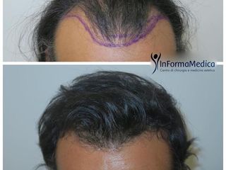 Trapianto di capelli prima e dopo