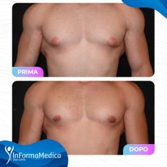 Ginecomastia - InFormaMedica - Centro di Chirurgia e Medicina Estetica