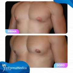 Ginecomastia - InFormaMedica - Centro di Chirurgia e Medicina Estetica