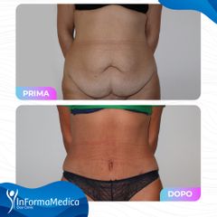 Addominoplastica - InFormaMedica - Centro di Chirurgia e Medicina Estetica