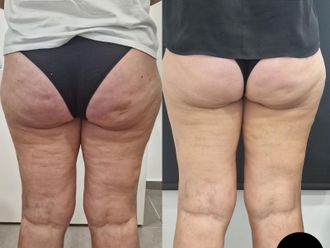 Mesoterapia prima e dopo - 871387