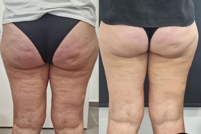 Mesoterapia prima e dopo - 871387