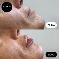 Filler labbra - Clynic Ostia