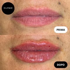 Filler labbra - Clynic Ostia