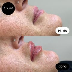 Filler labbra - Clynic Ostia