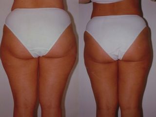 Liposuzione prima e dopo